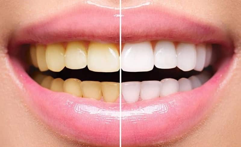 Mengatasi warna kuning pada gigi secara alami