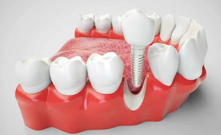 Ilustrasi kelebihan dan kekurangan implan gigi
