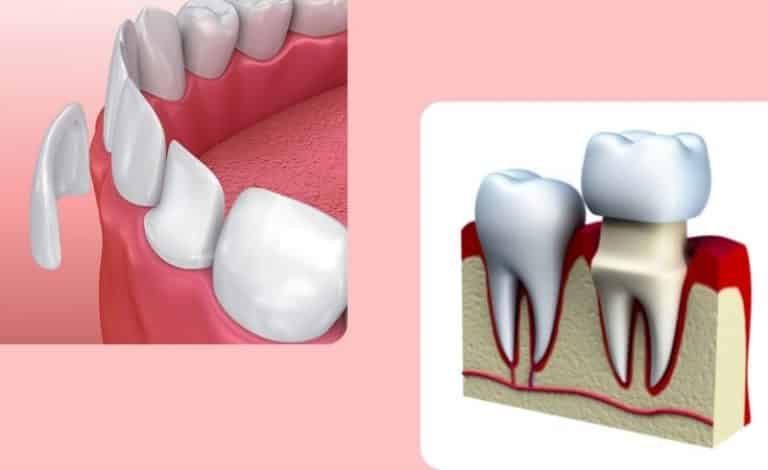 Ilustrasi veneer gigi vs crown gigi