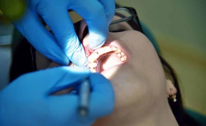 Penyebab Karang Gigi dan Pencegahannya, Ternyata Mudah!
