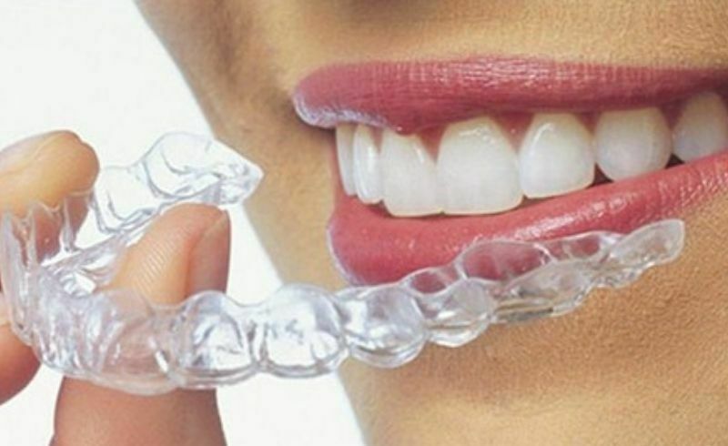 aligner