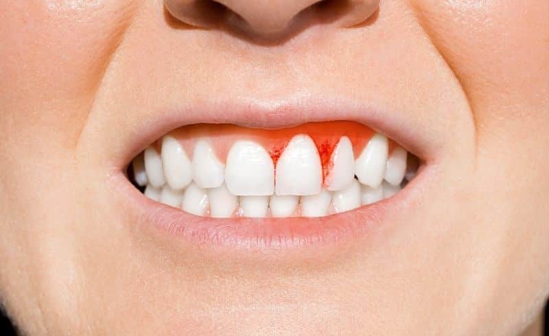 Ilustrasi gambar seseorang yang mengalami kondisi medis periodontitis di giginya