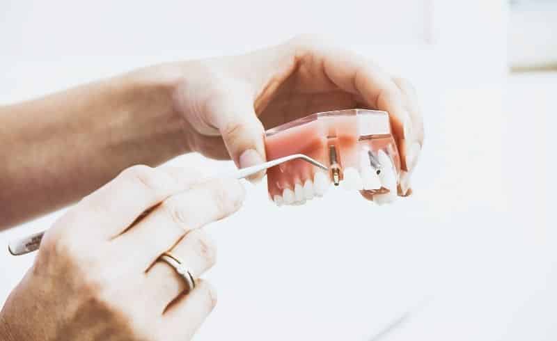 Cari Tahu Detail Layanan Dokter Gigi Spesialis Periodonsia