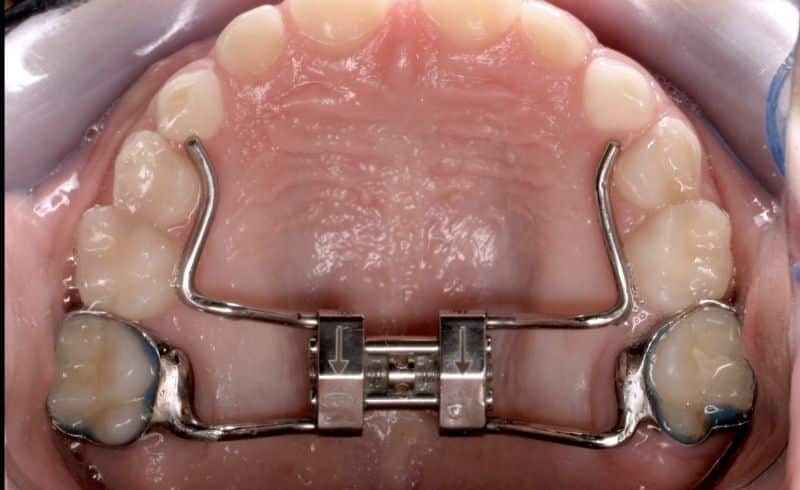 Palatal Expander