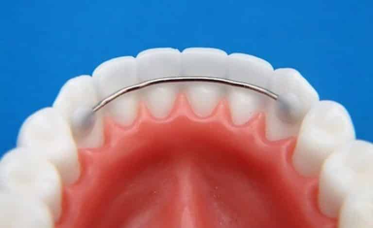 Keliatan Makin Cantik! Simak Fungsi dan Jenis Retainer Gigi Ini!