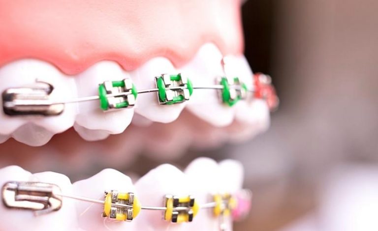 Ilustrasi gambar pemakaian behel palsu