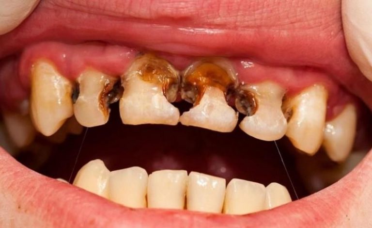 Cara Menghilangkan Gigi Hitam