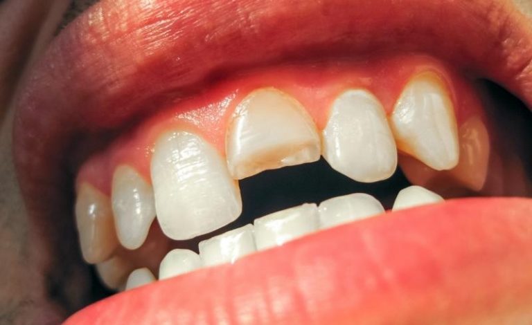 Gigi Patah Bagian Depan