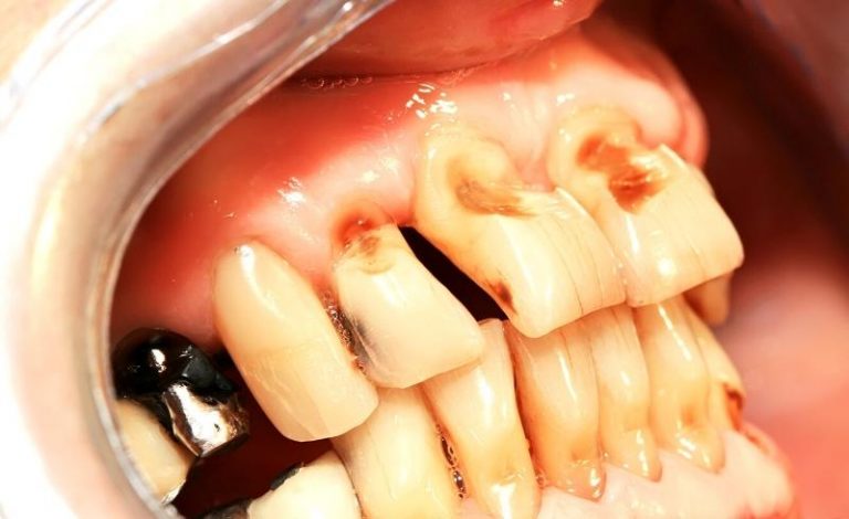 Ilustrasi kondisi abrasi pada gigi