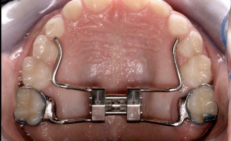 Palatal Expander