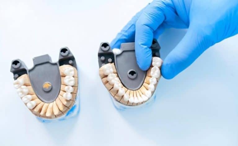 Ilustrasi pemasangan bridge gigi