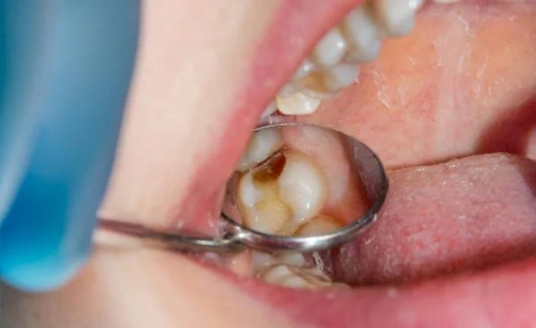 Penyakit Pulpitis Gigi