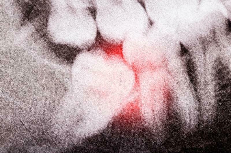 Gusi bengkak merupakan salah satu contoh gejala impaksi gigi