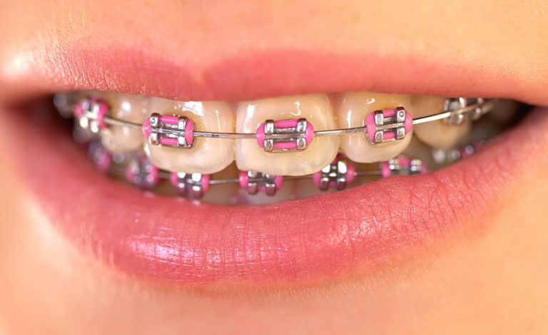 Efek pertama kali pakai behel