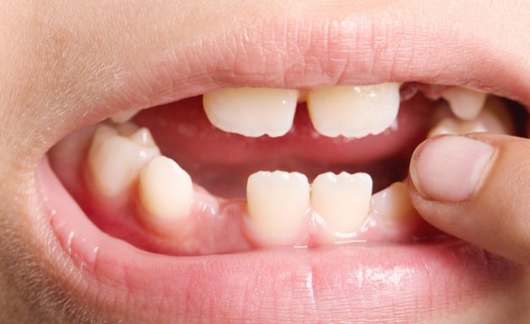 dampak gigi copot dibiarkan