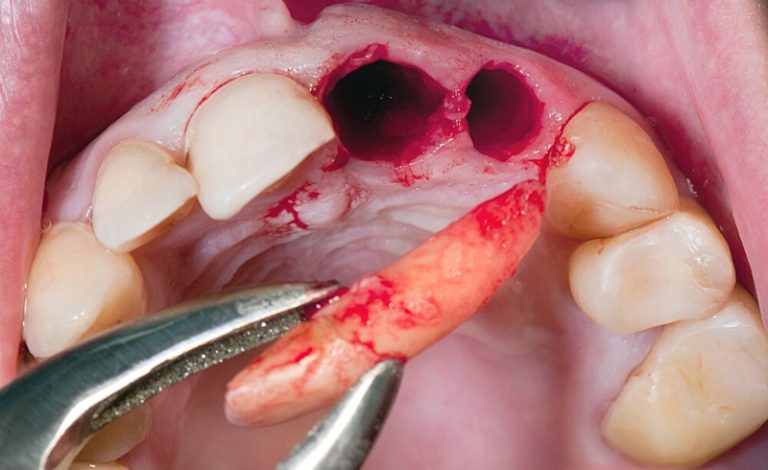 pencabutan kondisi gigi avulsi