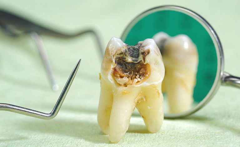 illustrasi gigi keropos karena minuman