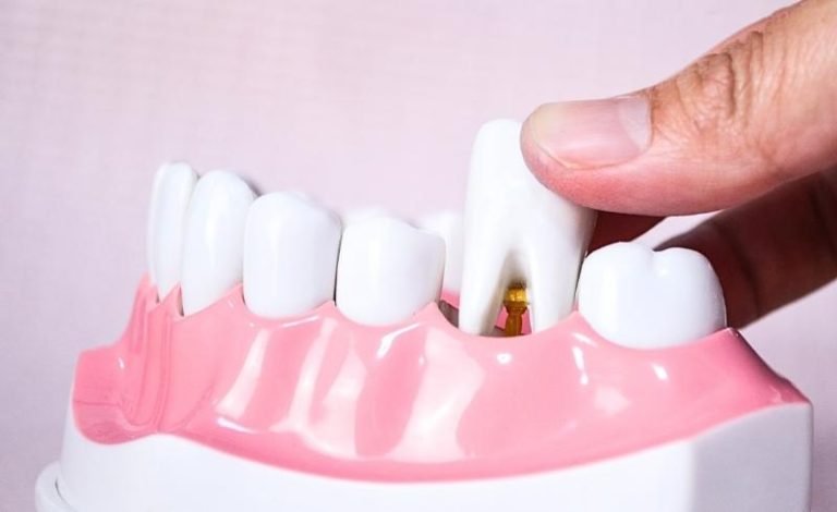 tanda-tanda infeksi setelah cabut gigi