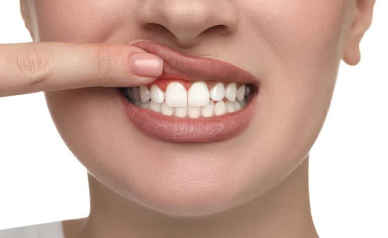 Prosedur layanan gingivektomi