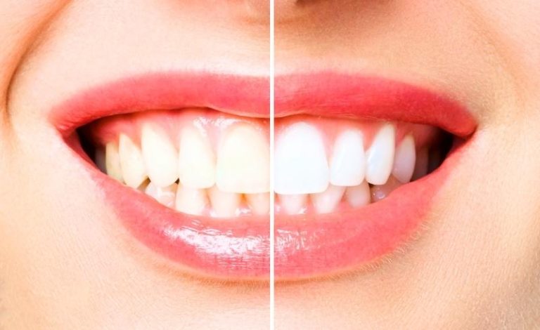 pantangan setelah bleaching gigi yang harus dihindari