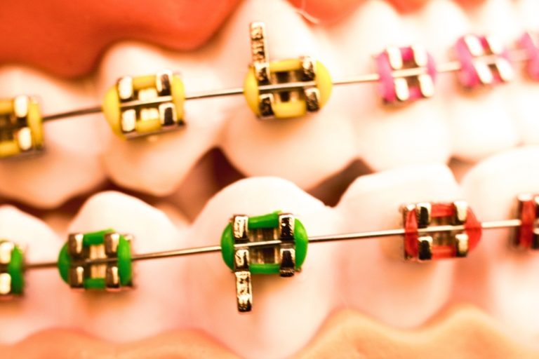 Layanan perawatan pemasangan behel gigi di klinik Axel Dental