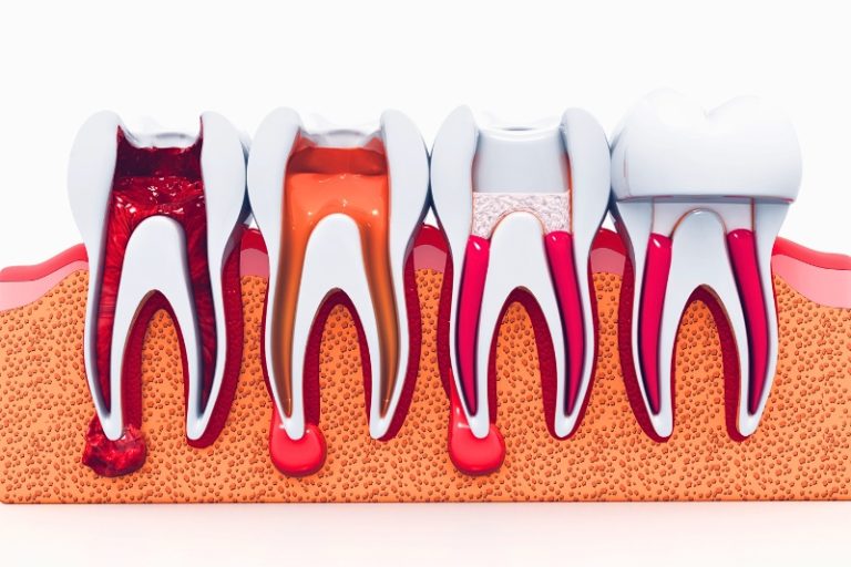 Layanan perawatan saluran akar gigi di klinik Axel Dental