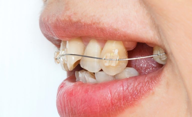 Jenis perawatan gigi gingsul