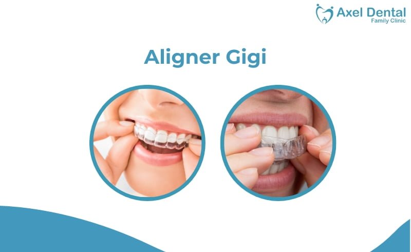 Aligner Gigi, Kenali Perbandingannya dengan Kawat Gigi