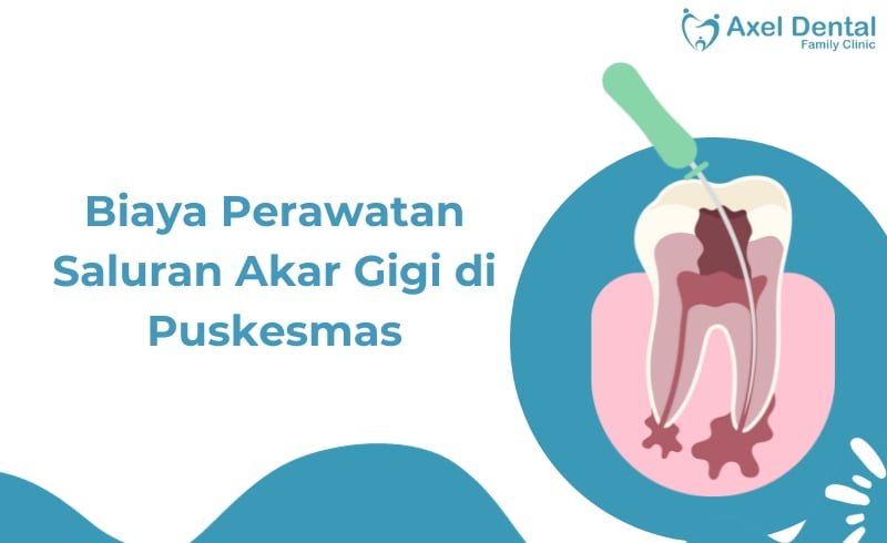 Biaya Perawatan Saluran Akar Gigi di Puskesmas Terdekat