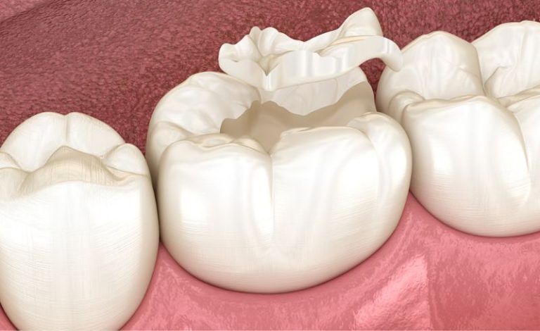 Biaya Tambal Gigi di Klinik Gigi