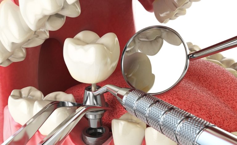 Harga Implan Gigi di Klinik Gigi