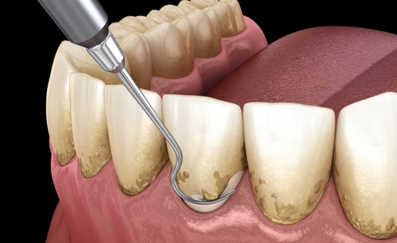 Harga Scaling Gigi di Klinik Gigi Axel Dental