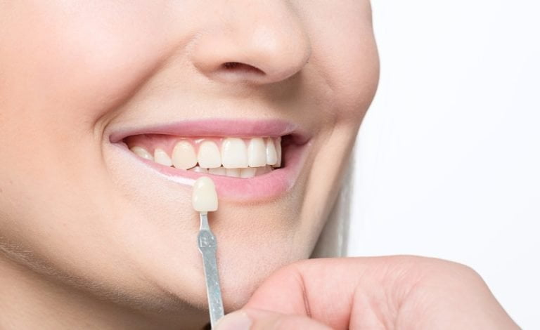 Harga veneer di klinik gigi