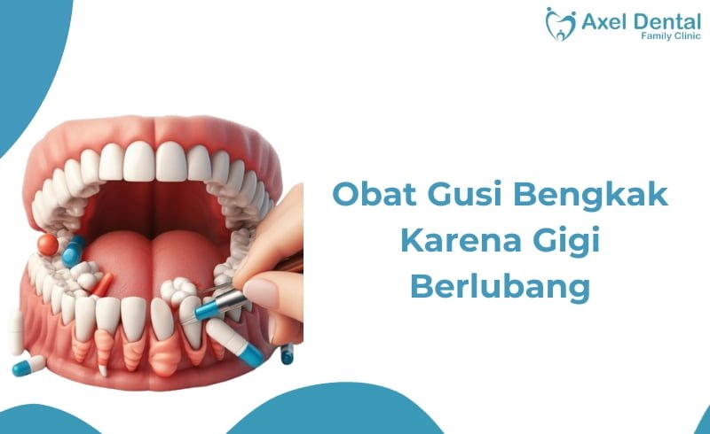 Obat Gusi Bengkak Karena Gigi Berlubang di Apotik dan Alami