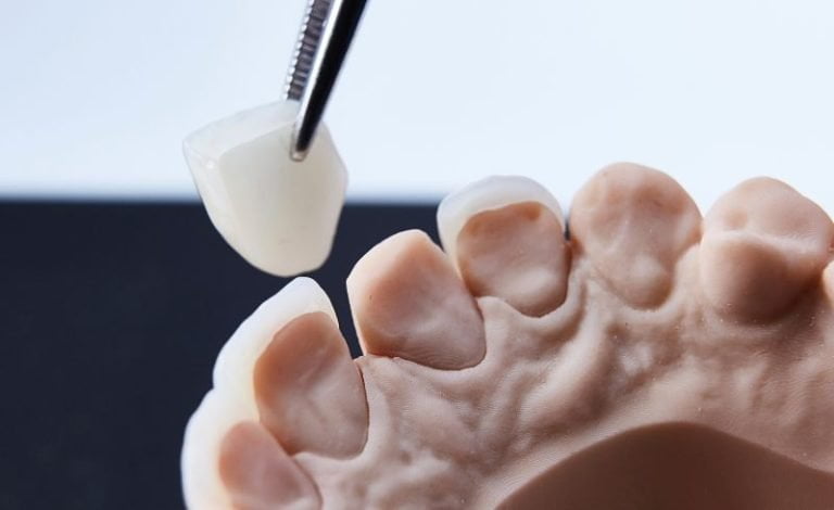 Penyebab Harga Mahkota Gigi Mahal