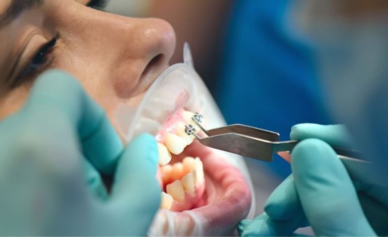 Dokter gigi sedang memasang behel pasiennya