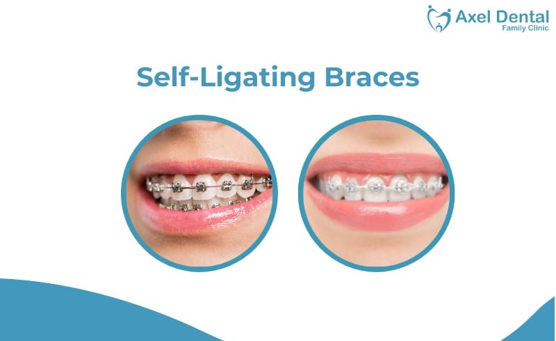 Self Ligating Braces: Manfaat, Kelebihan dan Harganya