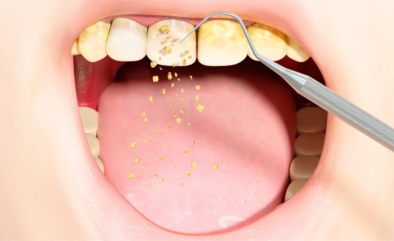 Syarat melakukan Scaling Gigi di Puskesmas