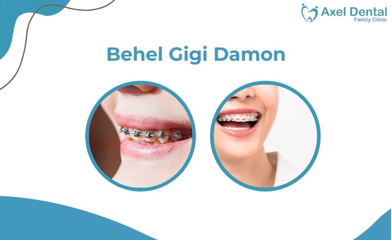 Behel Damon: Jenis, Harga dan Cara Merawatnya!