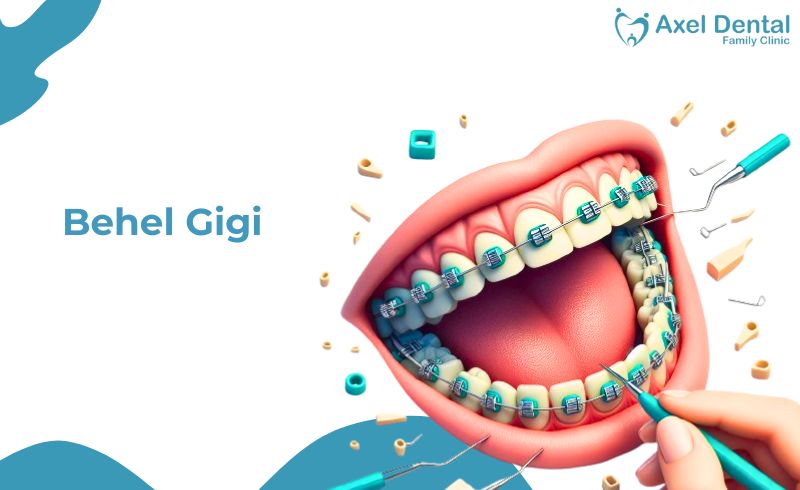 Behel Gigi: Jenis, Prosedur, Harga dan Manfaatnya