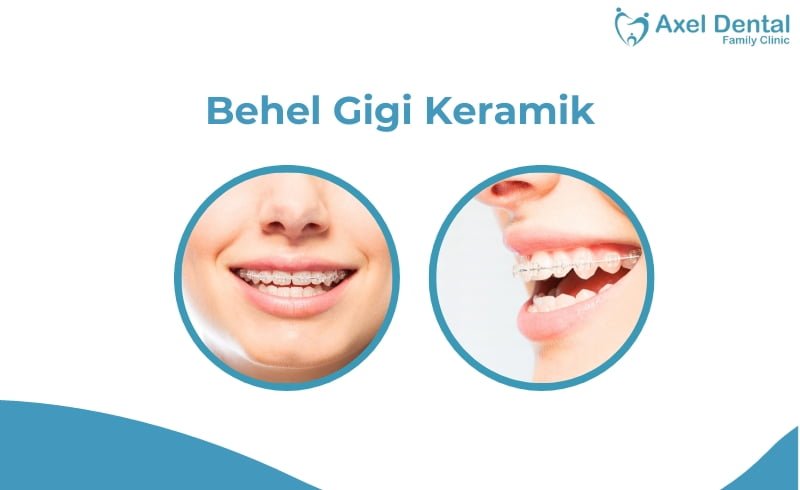 Behel Keramik: Jenis, Harga & Cara Merawatnya