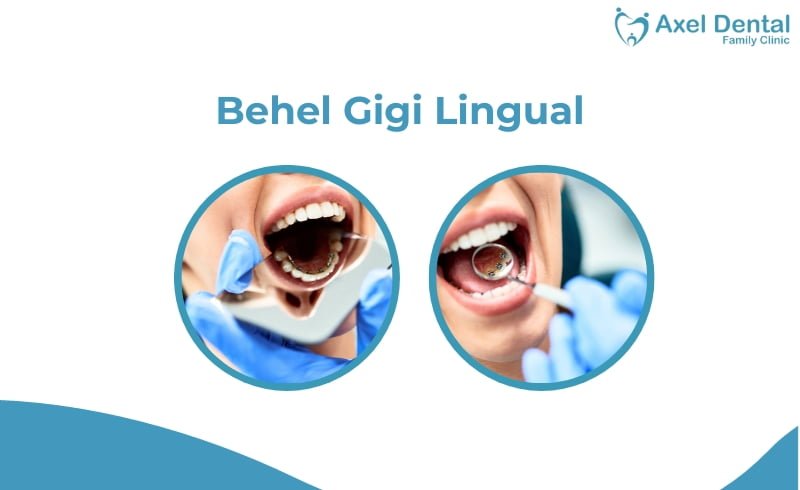 Kawat Gigi Lingual: Behel Tak Kasat Mata dan Harganya