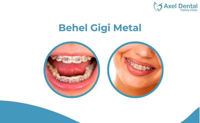 Behel Metal: Jenis, Kelebihan dan Cara Merawatnya