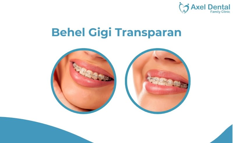 Behel Transparan: Jenis, Harga dan Cara Merawatnya