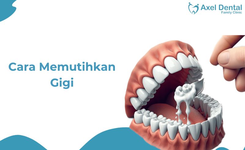 Cara Memutihkan Gigi dalam 1 Hari, Yuk Terapin!