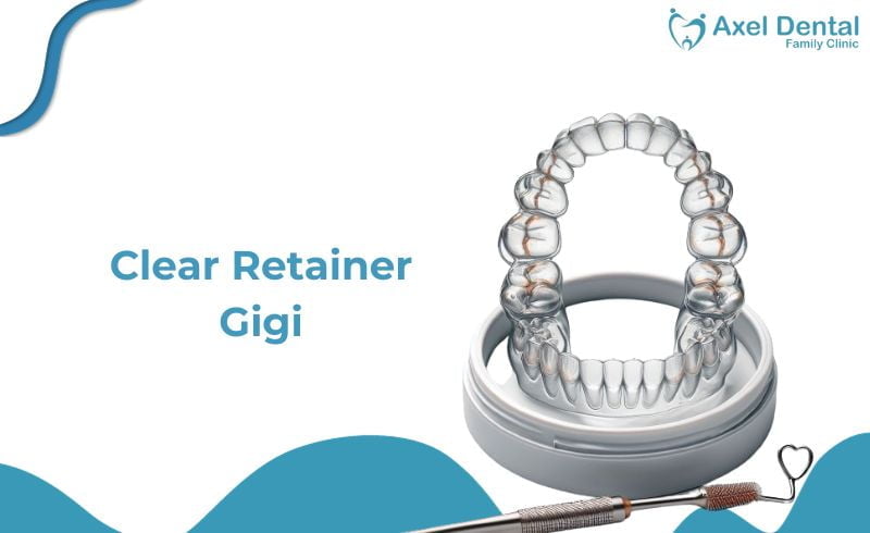 Clear Retainer: Jenis, Harga & Cara Merawatnya