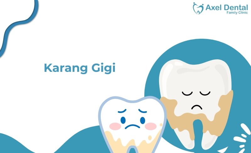 Karang Gigi: Penyebab, Pengobatan & Pencegahannya