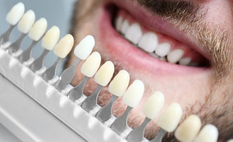 manfaat veneer gigi untuk memperbaiki masalah gigi