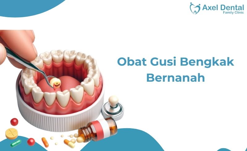 Obat Gusi Bengkak Bernanah di Apotek dan Secara Alami