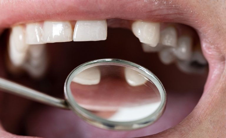 Hal yang menyebabkan gigi bisa ompong